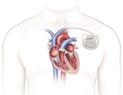 Schéma d'un pacemaker